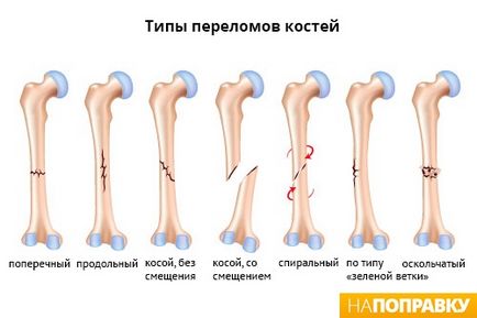 Перелом ноги симптоми і лікування - напоправку