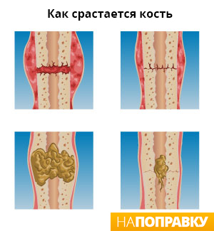 Перелом ноги симптоми і лікування - напоправку