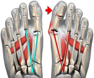 Пластир від кісточок на ногах (китайський магнітний hyperosteogeny, Сіньі 03, mlaolaod)