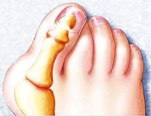 Tencuiala din oasele picioarelor (hiperosteogenia magnetică chineză, xinyi 03, mlaolaod)