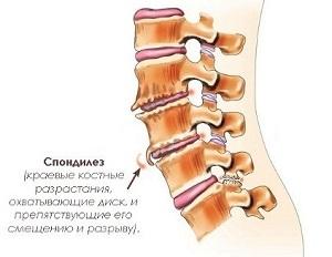 Чому болить поперек і що робити, щоб прибрати біль