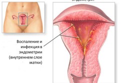 De ce menstruumul trece cheaguri întunecate