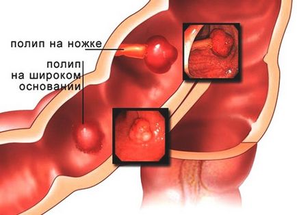 Polipii din cauza vezicii biliare, simptome, soiuri