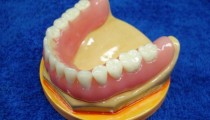 Постійні і знімні зубні протези