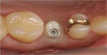Постійний зубний протез, стоматологічна клініка в Австрії доктора Ернста колба