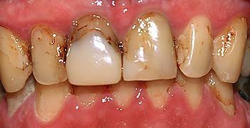 Постійний зубний протез, стоматологічна клініка в Австрії доктора Ернста колба