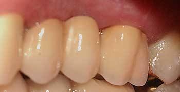 Proteza dentară permanentă, clinică dentară în Austria Flaconul Dr. Ernst