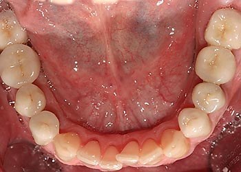 Proteza dentară permanentă, clinică dentară în Austria Flaconul Dr. Ernst