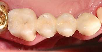 Proteza dentară permanentă, clinică dentară în Austria Flaconul Dr. Ernst