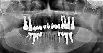 Proteza dentară permanentă, clinică dentară în Austria Flaconul Dr. Ernst