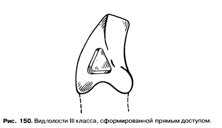 Disecția cavităților clasei a treia este un bun portal dentar, bun