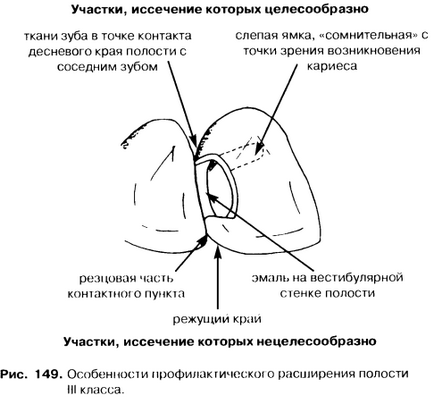 Disecția cavităților clasei a treia este un bun portal dentar, bun