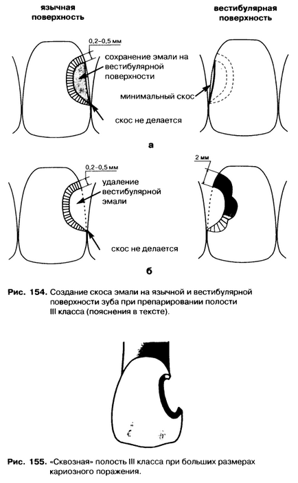 Disecția cavităților clasei a treia este un bun portal dentar, bun