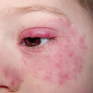 Cauze de roșeață în jurul ochilor, metode de terapie