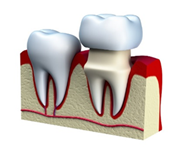 Протезування зубів в Казані - вставити зубні протези в клініці твій стоматолог