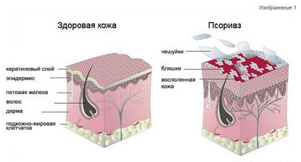 Псоріаз причини виникнення, види та методи лікування