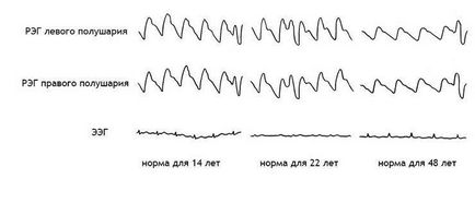 Regge (rheoencephalography) a vaselor cerebrale ceea ce este, decodarea, normele