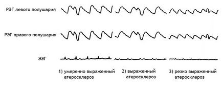 Regge (rheoencephalography) a vaselor cerebrale ceea ce este, decodarea, normele