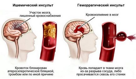 Regge (rheoencephalography) a vaselor cerebrale ceea ce este, decodarea, normele