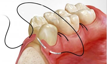 Indicații de rezecție a gingiei, efectuarea și consecințele operației