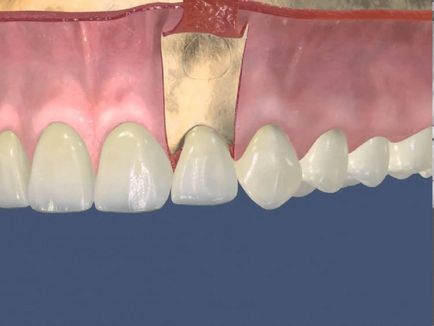 Indicații de rezecție a gingiei, efectuarea și consecințele operației