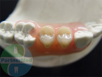 Силіконові зубні протези ціни, фото, відгуки пацієнтів