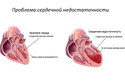 Simptomele insuficienței cardiace la bărbați