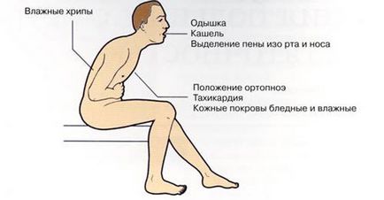 Симптоми серцевої недостатності у чоловіків (ознаки) - як виявляється