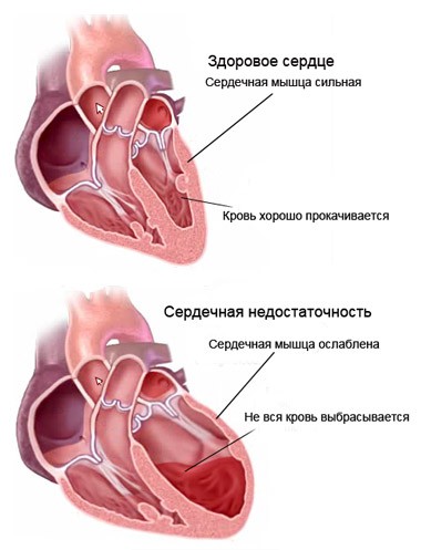 A szívelégtelenség tünetei férfiaknál - a szív-