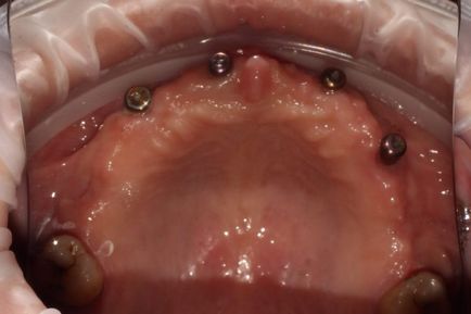 Compararea implanturilor dentare nobile