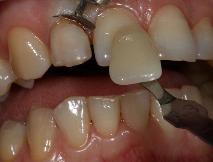 Стоматологи в шоці! ❤ відбілюємо зуби вдома! ❤