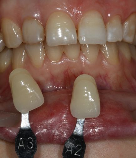 Стоматологи в шоці! ❤ відбілюємо зуби вдома! ❤