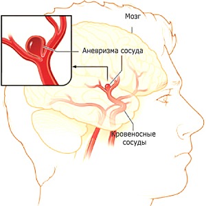Mérgező encephalopathia után dezomorfin - gyógyítani lehetséges