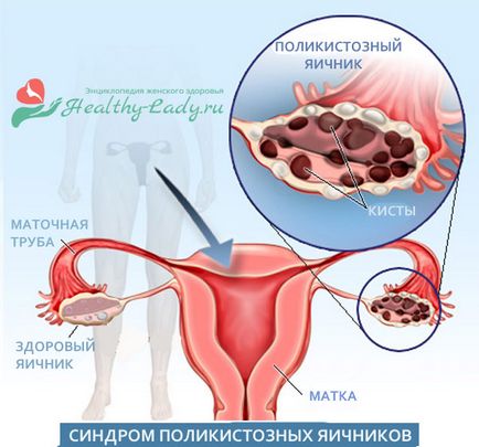 Все про синдром полікістозних яєчників (СПКЯ)