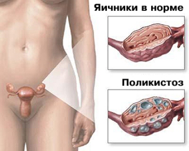 Totul despre sindromul ovarului polichistic (spka)