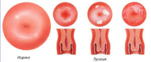 Întârziere în eroziunea menstruală a cataractei