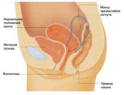 Îndoirea uterului