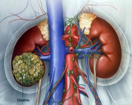 Întunecarea în rinichi este ceea ce poate fi și cum este vizibilă cocoașul de pe uzi