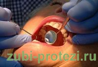 Зубні коронки види, порівняння плюсів і мінусів, фото, етапи установки, як доглядати