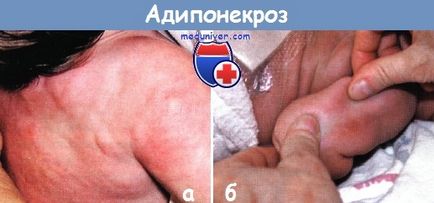 Adiponekroz (fokális nekrózis a szubkután zsír) csecsemők (adiponekroz) Adiponekroz (fokális nekrózis szubkután zsír) újszülött