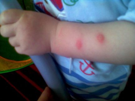Alergie la mușcăturile de țânțari la copii