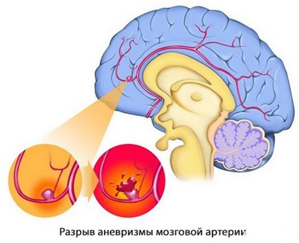 Anevrismul simptomelor vaselor cerebrale, ruptura, tratamentul și semnele