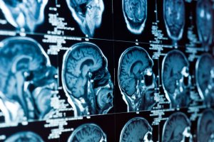Anevrismul simptomelor vaselor cerebrale, ruptura, tratamentul și semnele