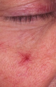 Angioma stellate - cauze, simptome, diagnostic, tratament, fotografie