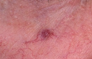 Angioma stellate - cauze, simptome, diagnostic, tratament, fotografie