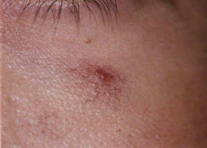 Angioma stellate - cauze, simptome, diagnostic, tratament, fotografie