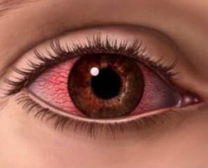 Angiopatia retinei provoacă patologia și tratamentul