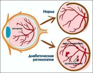 Angiopathy retina patológia okok és a kezelés