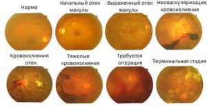 Angiopathy retina patológia okok és a kezelés