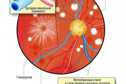 Angiopatia cauzată de retină, simptome, tratament